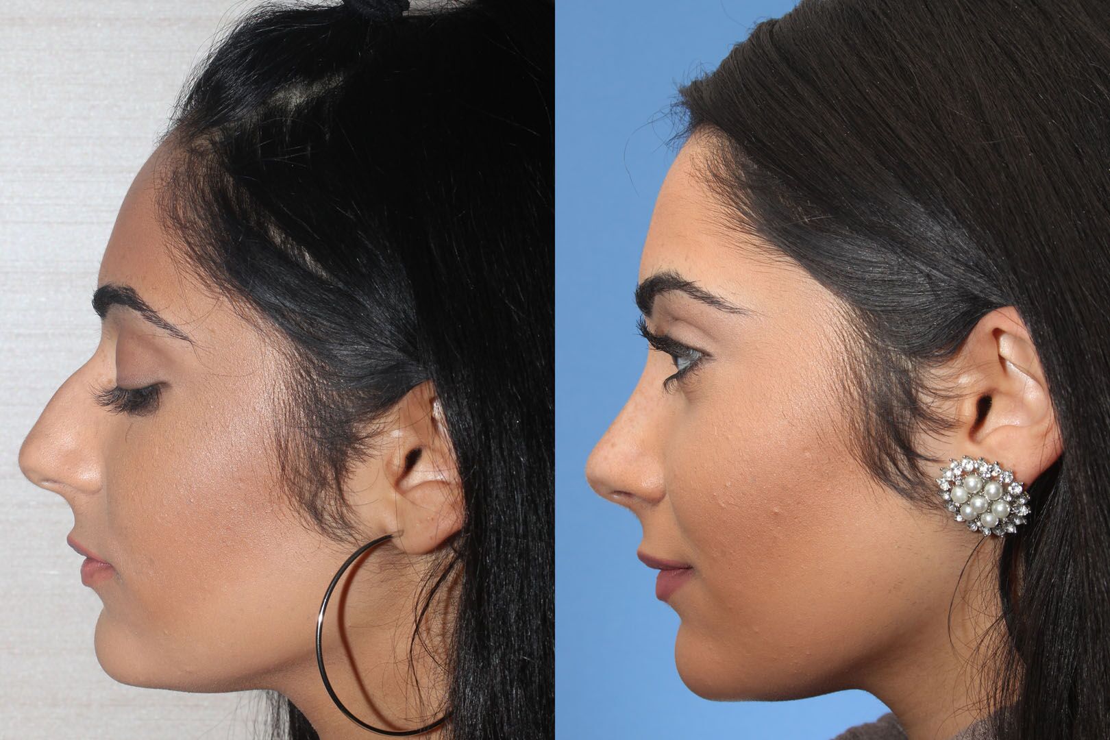 Nose Reshaping