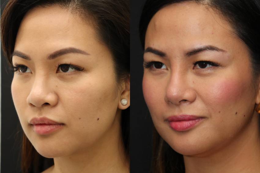 Asian Rhinoplasty Surgery in Toronto | Solomon Facial Plastic